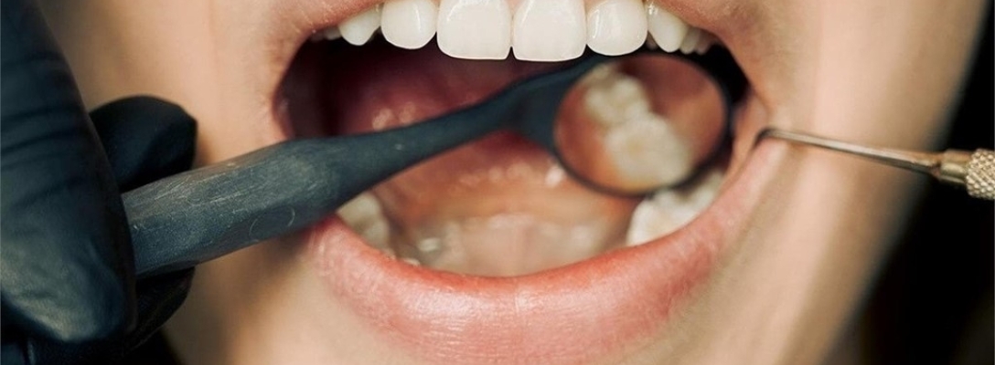 7 ventajas de los implantes dentales
