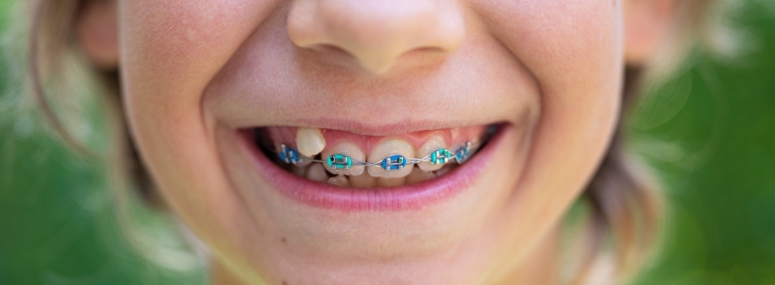 Aparatos dentales para niños: Qué tipos existen y qué corrigen