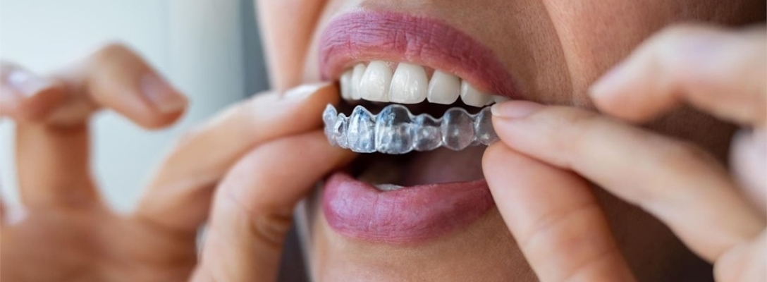 ¿Cuánto tiempo hay que llevar la ortodoncia invisible?
