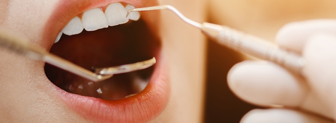Cuidados después de un empaste dental: Qué debes hacer y qué no