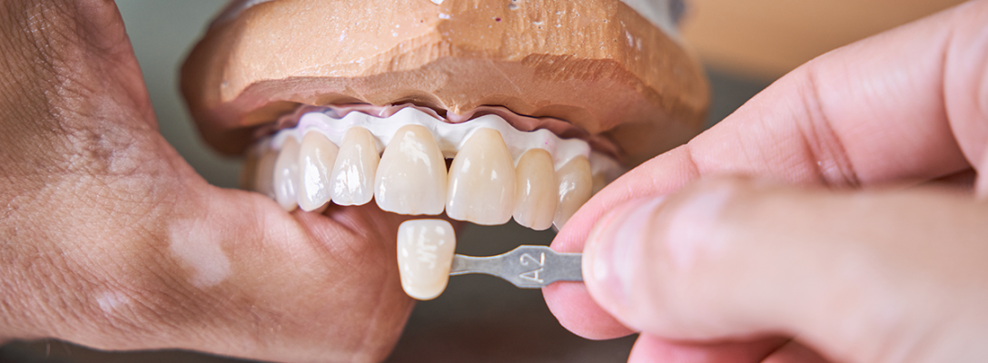 Diferencias entre carillas dentales y coronas