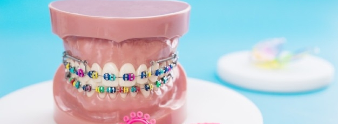 Consejos para una correcta higiene bucal con brackets