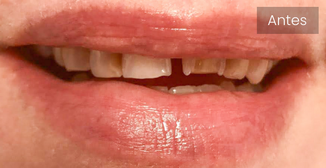 Carillas dentales antes  | Dentistas en Ferrol