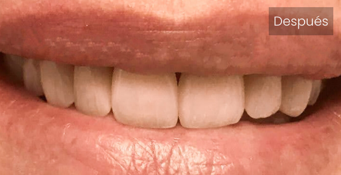 Carillas dentales después | Clínicas dentales en Ferrol