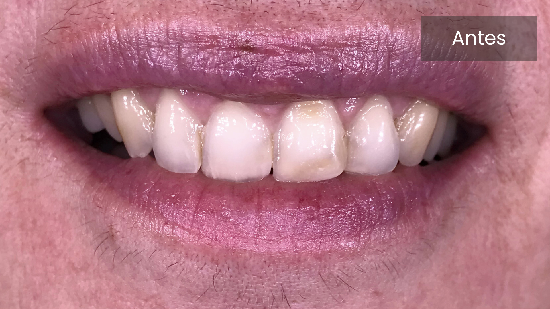 Carillas dentales antes  | Dentistas en Ferrol