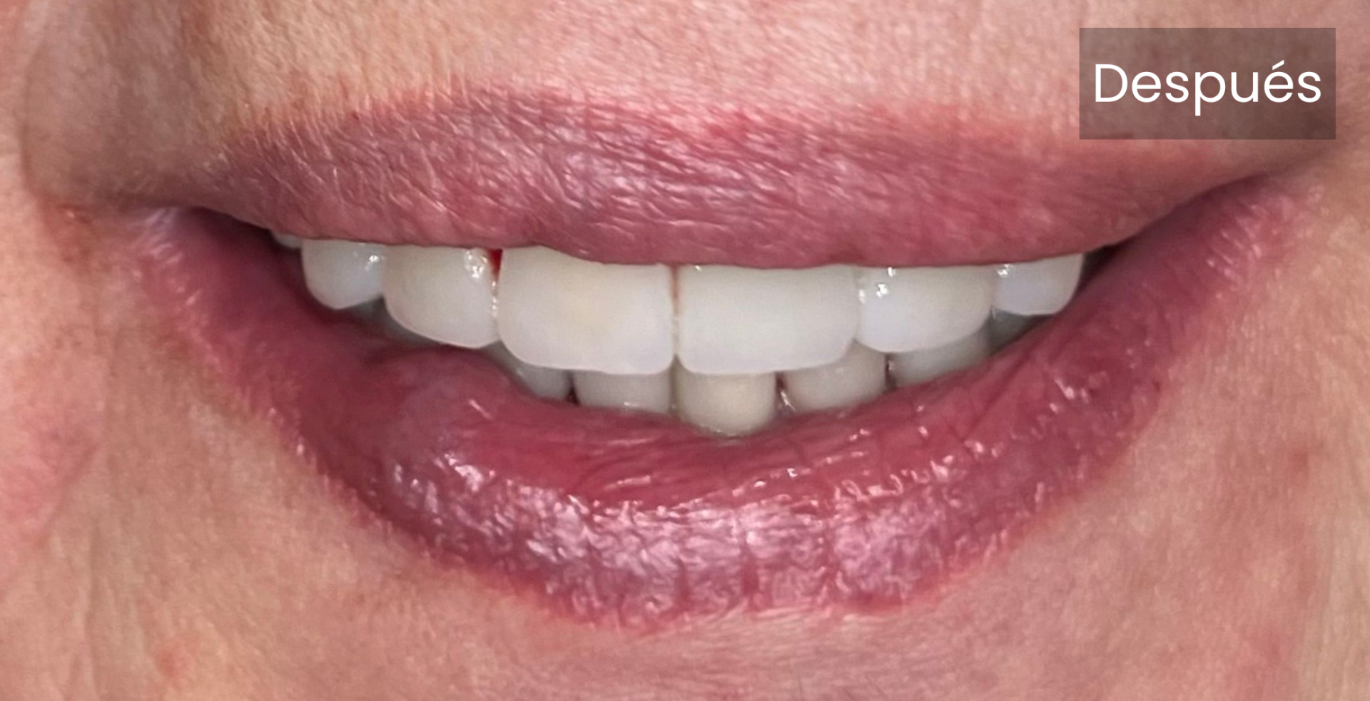 Carillas dentales después | Clínicas dentales en Ferrol