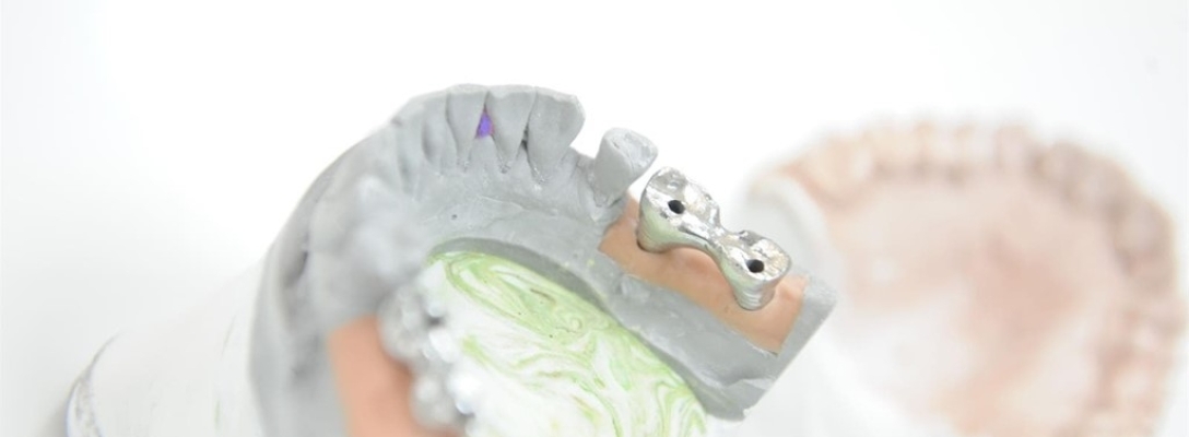 Implantes dentales: ¿cuál es el proceso hasta lucirlos?