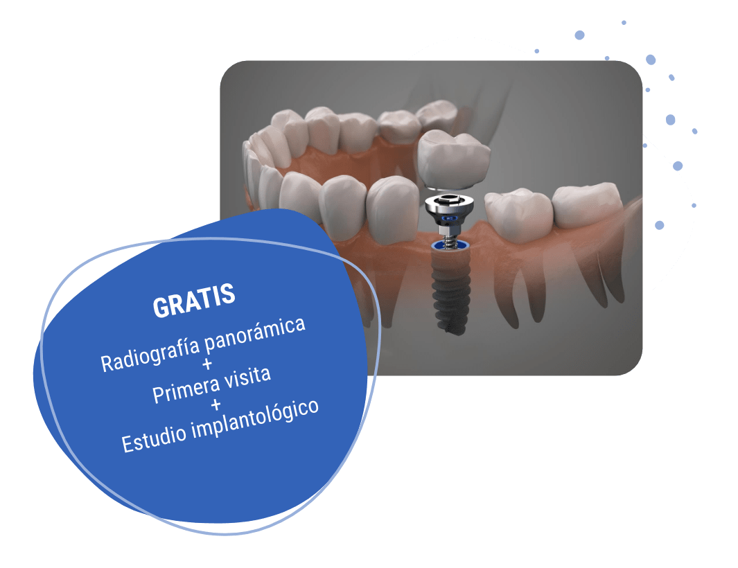 Implante dental en 3D