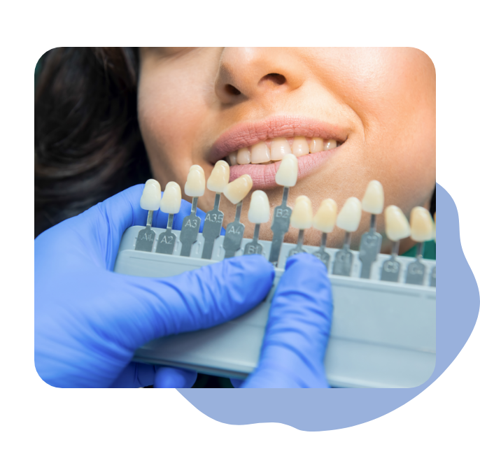 Eligiendo el color de los dientes para el blanqueamiento dental