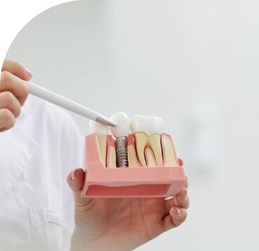 Implantes dentales en Santiago de Compostela 