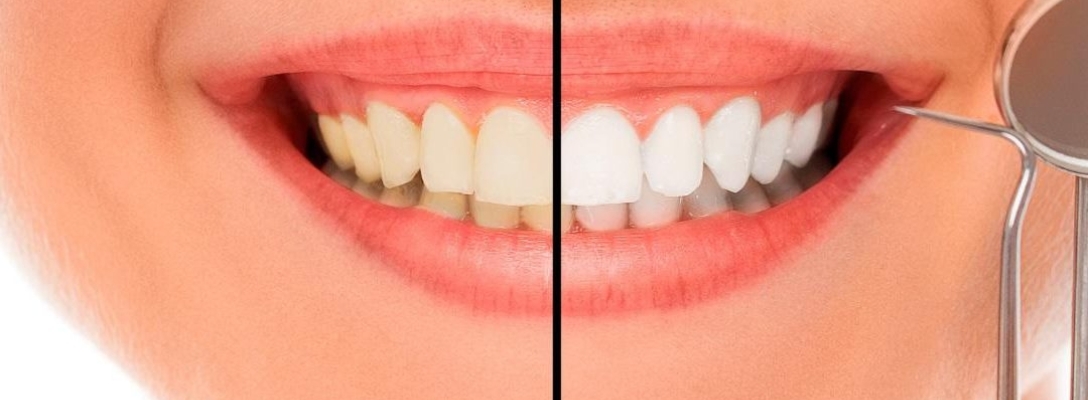 ¿Qué tipos de blanqueamiento dental existen?